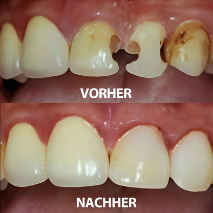 ✅ Hergestellt und versendet aus Deutschland | Rolimey® Transforming Growth Factor-β (TGF-β) Mundspülung zur oralen Reparatur❤️❤️
